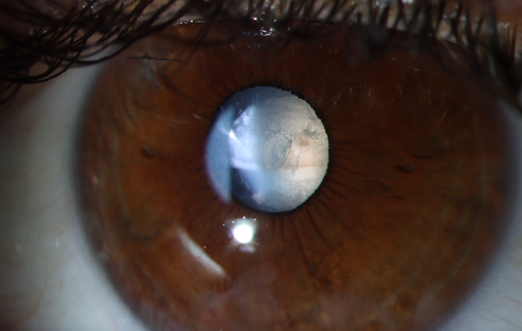 White cataract one week after capsular violation.